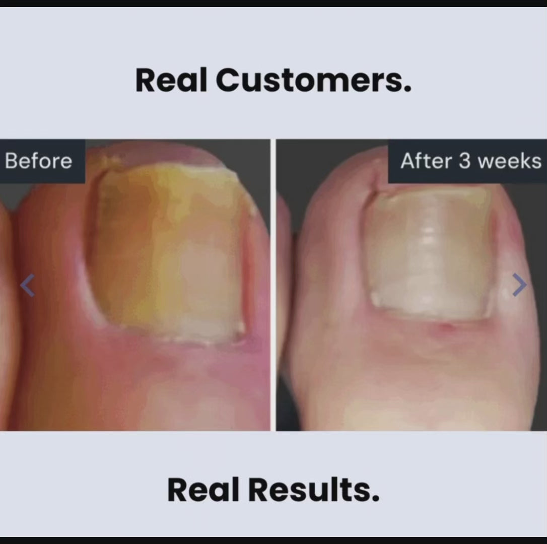 Arixa™ Antifungal Pen